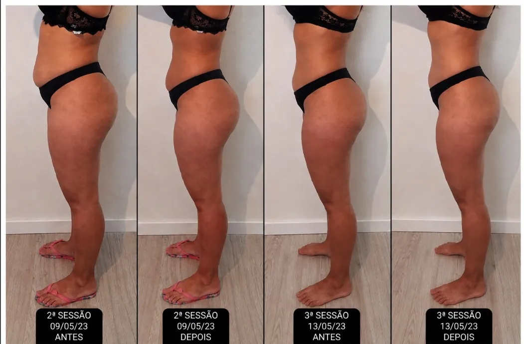 Antes e depois de modelagem corporal em pernas e glúteos, evolução por sessões